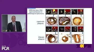 Advancements in intracoronary imaging and intervention: unmasking vulnerable plaques - EuroPCR
