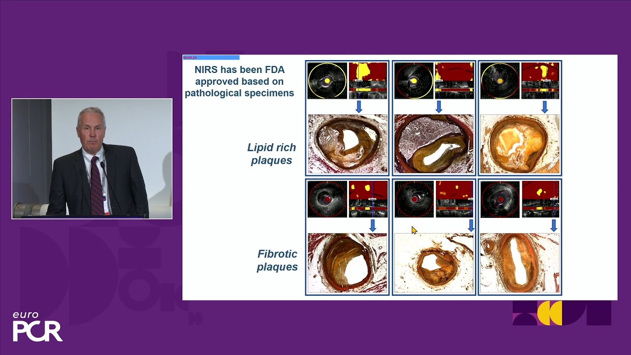 Advancements in intracoronary imaging and intervention: unmasking vulnerable plaques - EuroPCR