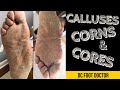 Calluses, Corns, and Cores