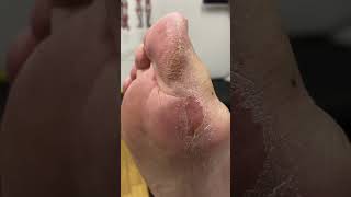 Dive Into The World Of Podiatry With Our Latest Video On Big Toe Callus Removal!
