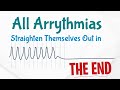 Arrhythmia in icu lecture recording english