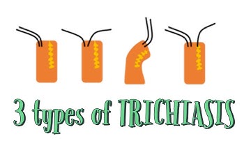 3 types of Trichiasis: Distichiasis, Entropion and Trichiasis (EyeDocSkills)