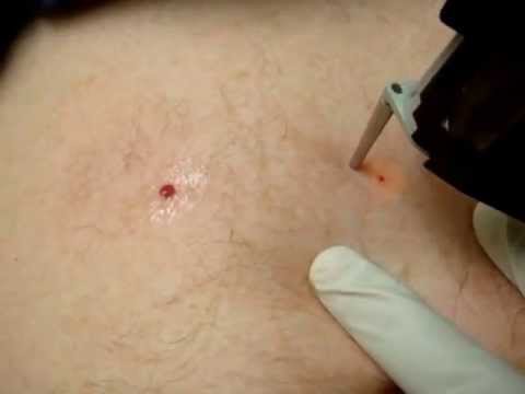 Cherry Angiomas (Red Moles) Treatment - YouTube