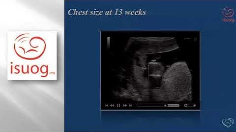 1st trimester fetal echo