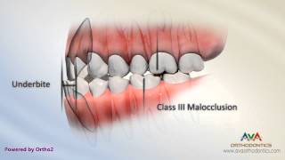 Malocclusion - Underbite or Crossbite