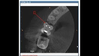 Carestream 3D Imaging - Creating Arrows and Annotations