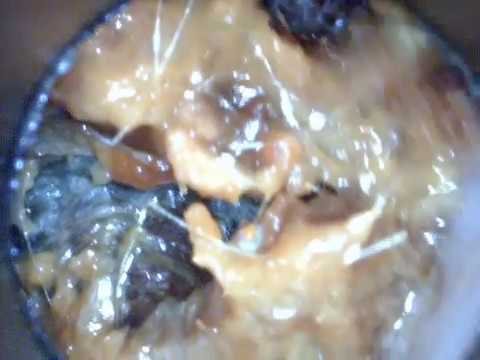Ear Wax Removal.  The largest ear wax plug in the world removed with jobson horn
