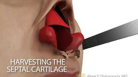 Rhinoplasty procedure animation