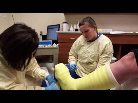 Total Contact Cast for Diabetic Foot Ulcers | IU Health