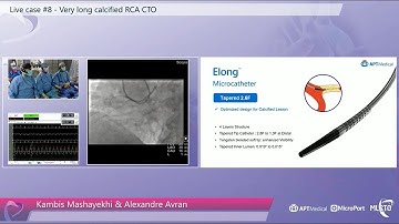 Very long calcified RCA CTO - MLCTO 2022