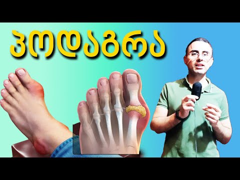 გააკეთე ეს! პოდაგრამ რომ არ შეგაწუხოს