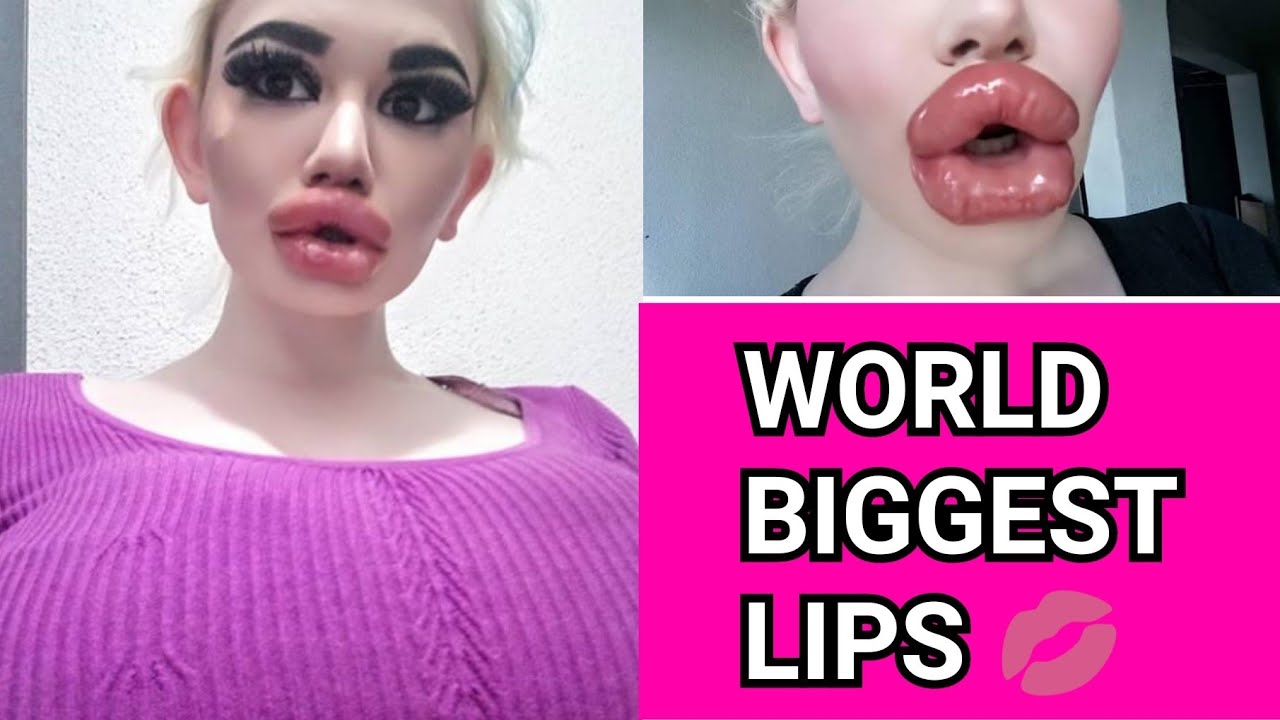 Women With Biggest Lips In The World Shows Off Huge New Pout After Th