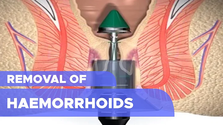 Removal of Haemorrhoids