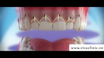 CƯỜI HỞ LỢI KHIẾN BẠN KHÔNG THỂ TỰ TIN CƯỜI HẾT CỠ.