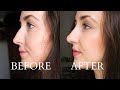 My NON-SURGICAL NOSE JOB Experience! Everything that you need to know about the procedure