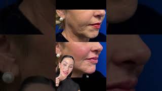 Full Face Rejuvenation | CO2 Laser, Botox & Filler ✨