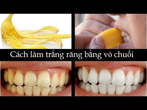Video: Làm thế nào để điều trị nhiễm trùng ở răng khôn (có hình ảnh)