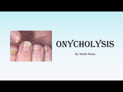 Video: Kokie vaistai sukelia onicholizę?