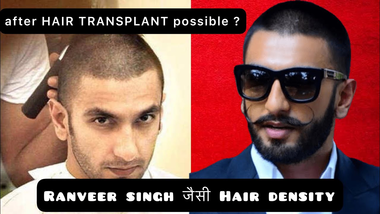 10 months Hair transplant results  Ranveer Singh look Hair transplant  results  YouTube