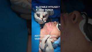Stable Vitiligo on Face? MINI PUNCH GRAFTING ✨Natural repigmentation | Confidence restored 🙌Dr Sen