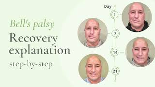 Bell&#39;s palsy recovery: Step-by-step explanation