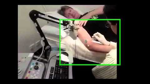 Botox injections in arm for MS (Multiple Sclerosis)