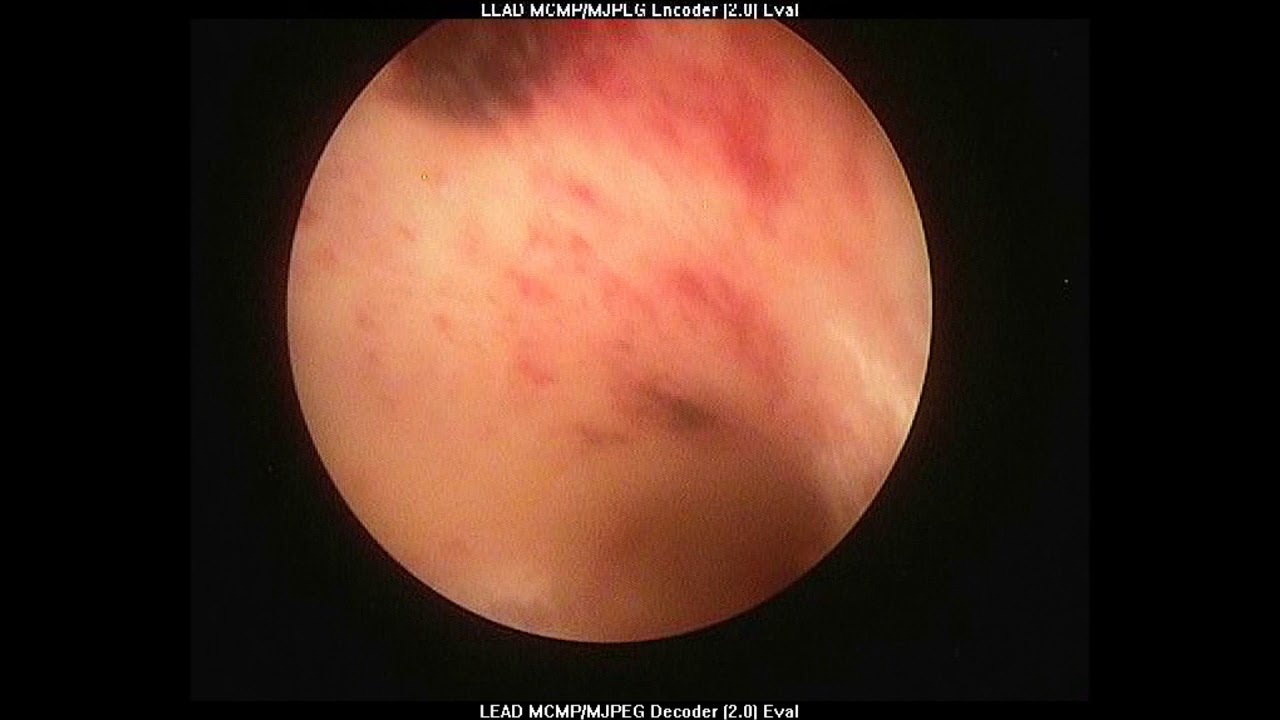 Endometritis cronica como se cura Endometritis cronica como se cura