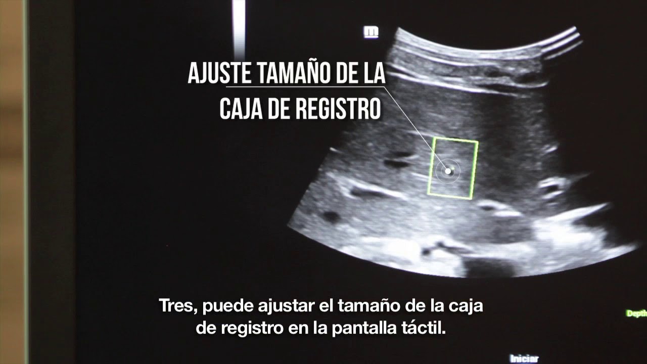 Mindray Elastografía Cuantitativa Sound Touch Elastography