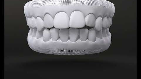 NIỀNG RĂNG KHỚP CẮN HỞ