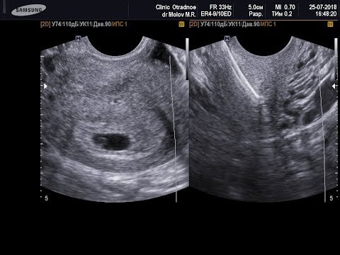 Внутриматочная спираль + беременность (25-7-18) Беременность на фоне спирали