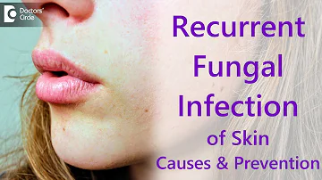 Why do i get recurrent fungal skin infections? - Dr. Amee Daxini