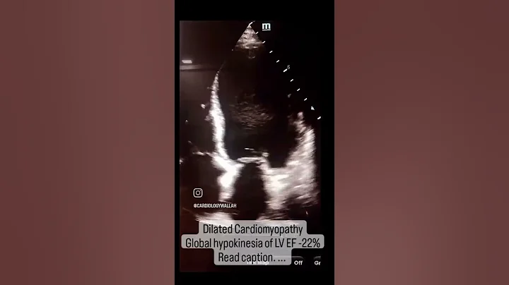 Dilated Cardiomyopathy hypokinesia of LV Echocardiography