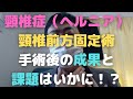 頸椎症の前方固定術を受けた結果をお伝えします！【メリットとデメリット】Cervical spondylosis　Results of surgery