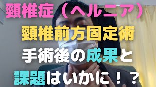 頸椎症の前方固定術を受けた結果をお伝えします！【メリットとデメリット】Cervical spondylosis　Results of surgery