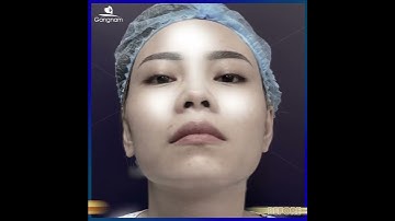 Khắc Phục Mũi Hỏng Bằng Nâng Mũi Cấu Trúc 3D