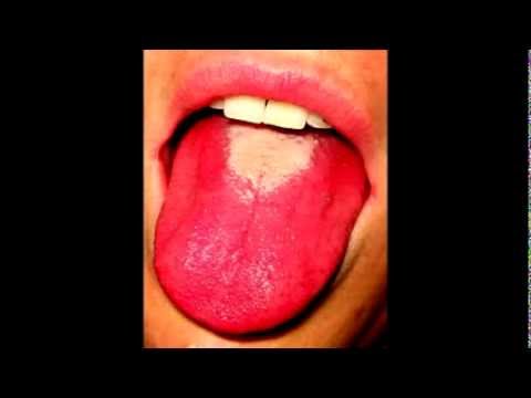 Strawberry tongue - Causes