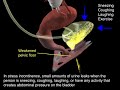 Retropubic slings  surgical treatment for urinary incontinence  anatomical 3d visualization