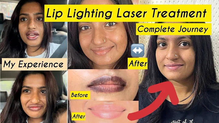 I paid money to get horse lips 💋👄 Lip Lighting Laser | My experience 😫😱
