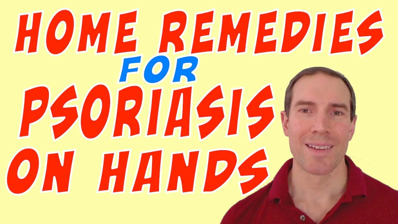 Home Remedies For Psoriasis On Hands Youtube