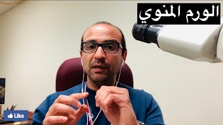 الورم المنوي Seminoma