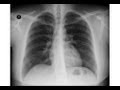 Chest x-ray - Heart failure, Kerly B lines, Pulmonary edema with Histology correlation