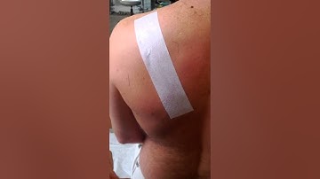 Taping for posterior scapular tilt