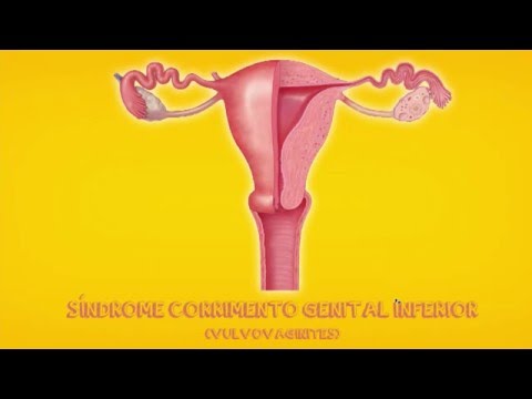 Vídeo: Vulvovaginite: Causas, Sintomas E Diagnóstico