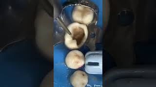 ¡HOYO GIGANTE eliminando caries dental en una muela!