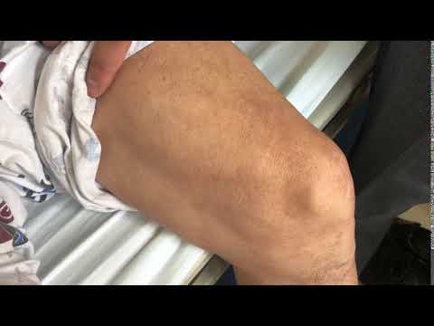 Fasciculation, r/o ALS