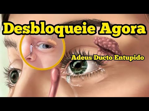 Exercícios Para Consertar Um Ducto Lacrimal Bloqueado Sem Fazer Cirurgia