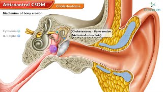 Atticoantral Chronic Suppurative Otitis Media (CSOM) and Cholesteatoma 🦻💡" / Animated ENT Lectures