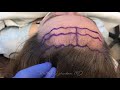 Forehead Reduction / Hairline Advancement with Before and After Photos - Dr. Matthew Richardson