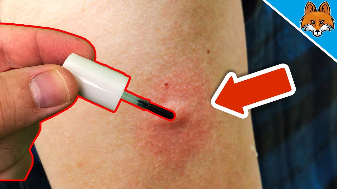 this-will-make-your-mosquito-bite-stop-itching-immediately-genius