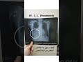 صورة الإلتهاب الرئوى الحاد فى الأشعة السينية على الصدر